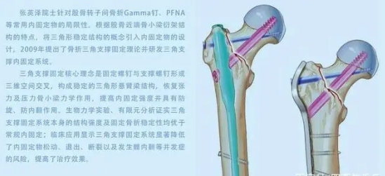 學(xué)科(kē)力量丨烟台海港医院骨外一科(kē)：PFBN治疗股骨粗隆间骨折，首例手术成功！