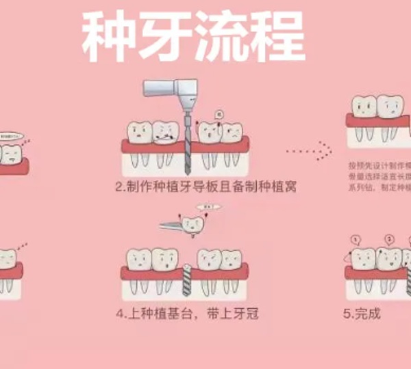 一颗种植牙，给您稳稳的安全感